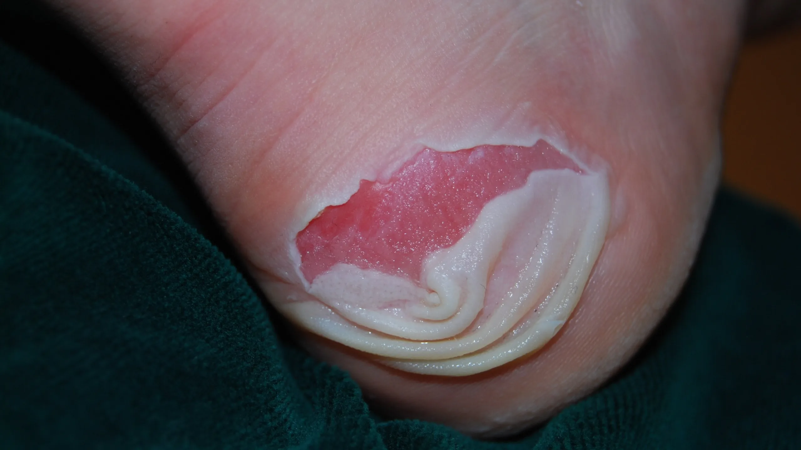 Ampoule déchirée au talon, laissant apparaître une zone de peau rouge à vif.