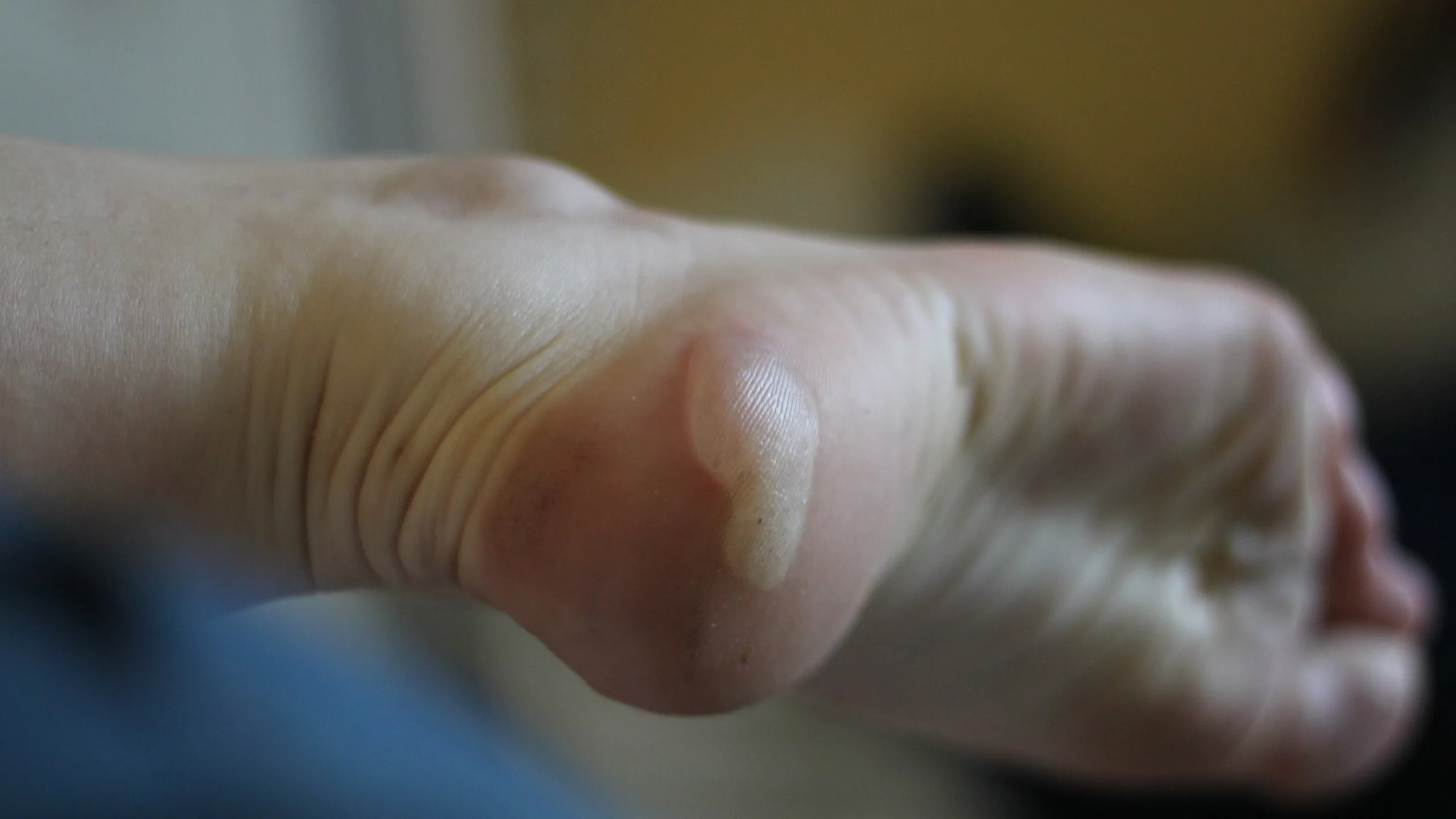 Gros plan d'une ampoule intacte, remplie de liquide, sous le talon d'un pied.