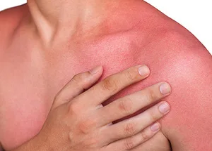 Le coup de soleil, douloureux et parfois dangereux